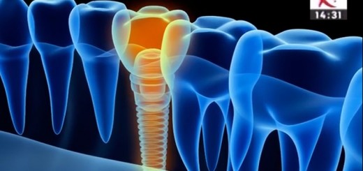 Spot Reluare DSE - Punte versus implant dentar