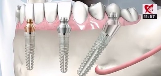 Spot Reluare Diferente si Esente - Noile tehnologii in implantologia dentara