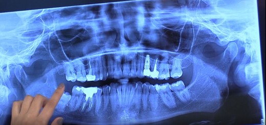 Spot Reluare DSE - Radiografia dentara digitala si rolul computerului tomograf - Clinicile Dr. Leahu - Realizator Cecilia Caragea